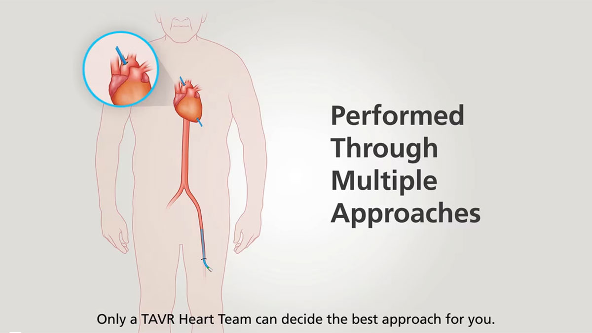 Edwards Life Sciences - TAVR